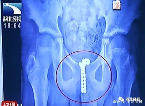 12岁男孩将39颗珠子塞进尿道,手术时医生傻了