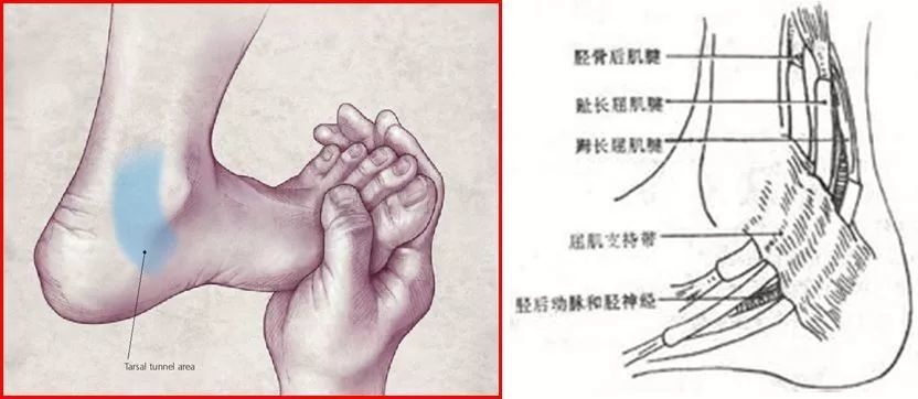 跟腱炎:跟腱止点疼痛和压痛明显 跟骨滑膜炎或跟腱滑膜炎:跟骨结节