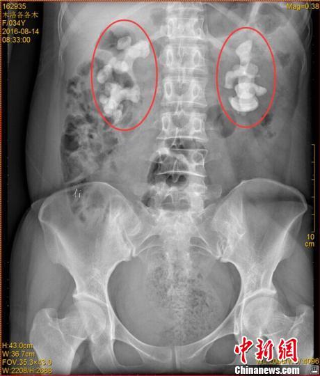 女子喝生水30余年 双肾长10厘米巨型结石(图）