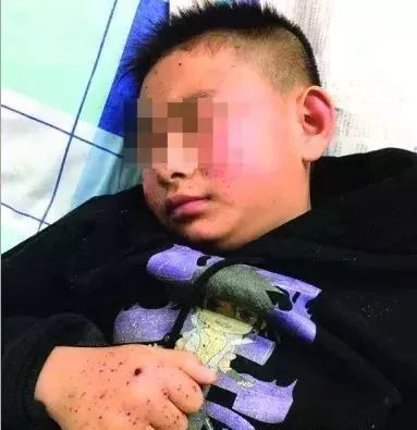2018年2月13日,三名孩子放炮被炸伤,其中一人左眼感染严重,可能需要被