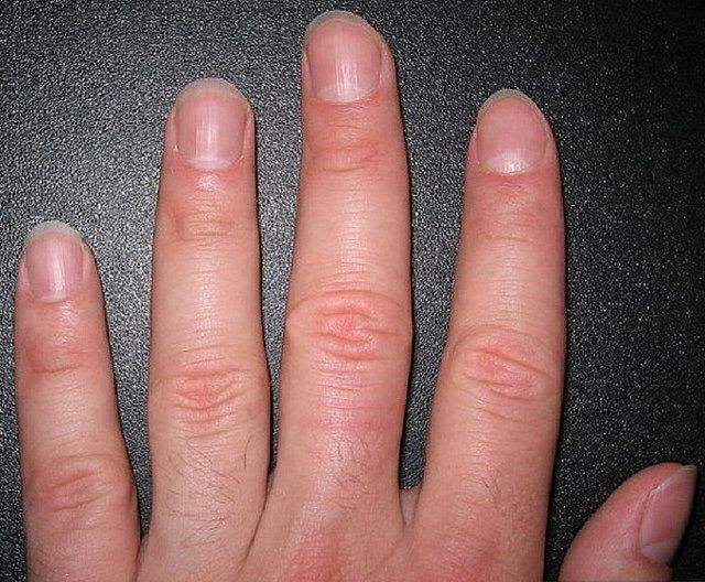 肺癌早期易显露,手指若出现2个"变化,有一个也要去检查!