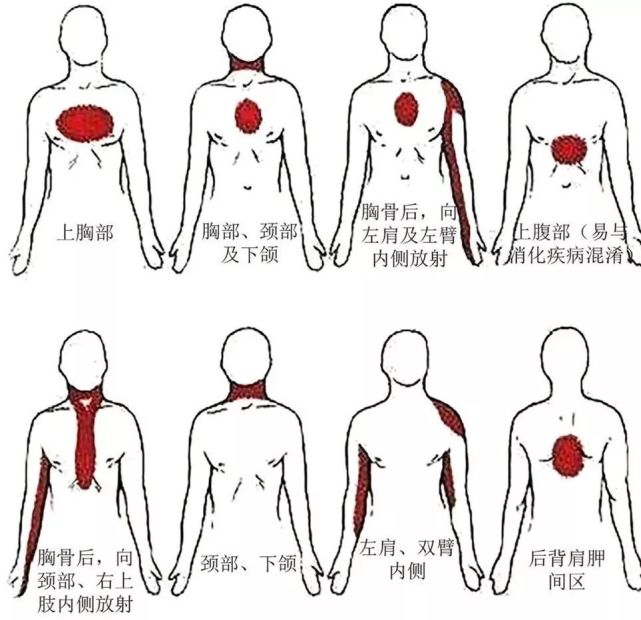 心绞痛部位为一个中心(胸骨中上段),上下一条线(上至咽部,下至剑突)