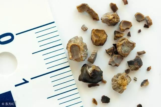 肾结石病人不能吃这四种食物,一定要管住你的嘴