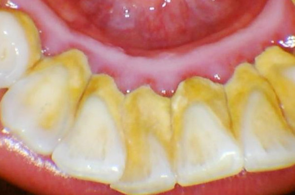 牙齿上的黄泥是什么?如何才能去除?