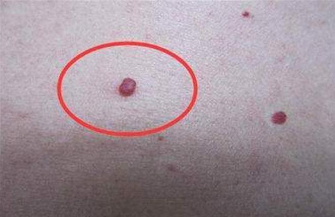 肝癌不痛不痒,一旦身上长这种"小红点",可能癌症离你更近一步