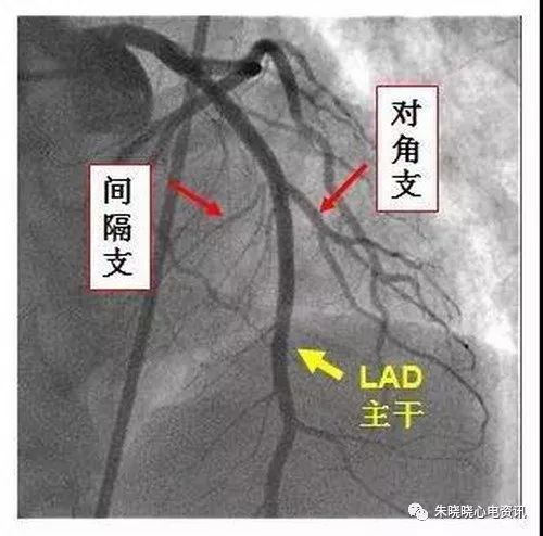 掌握这5招,轻松"锁定"心梗罪犯血管!