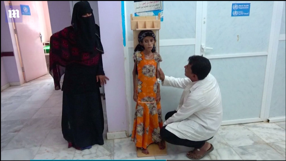也门内战将人推向饥荒边缘 12岁女孩18斤瘦得像
