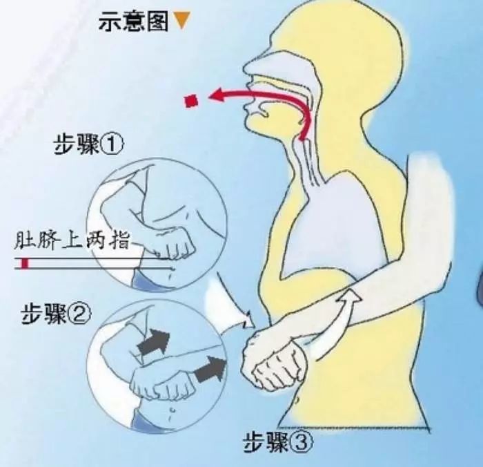 给娃吃汤圆小心噎着,急救黄金5分钟,海姆立克法必学