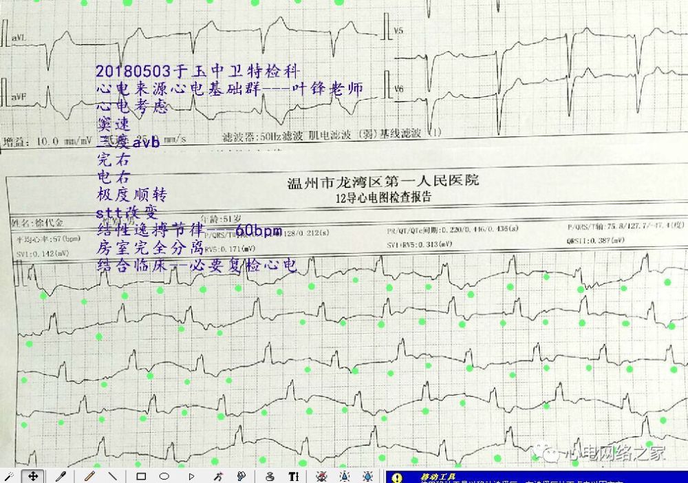 心电图实例解图系列127-三度房室传导阻滞心电系列