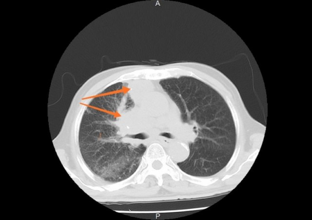 一男子年年体检竟查出晚期肺癌,专家:x光片难发现早期