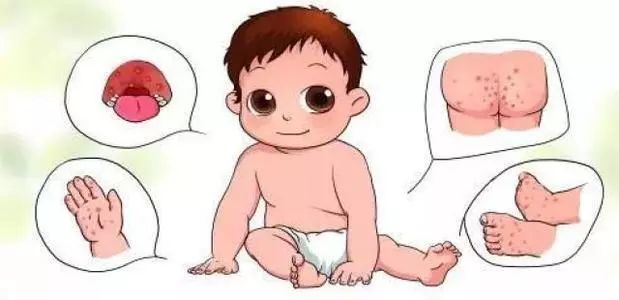 娃研所丨手足口病近期高发,关于EV71疫苗需要