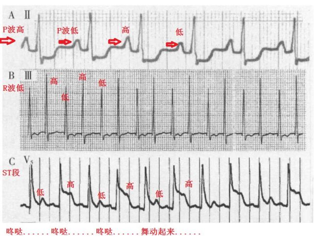 心脏电交替现象指来自同一起搏点的心搏,其心电图波形,振幅,极性呈