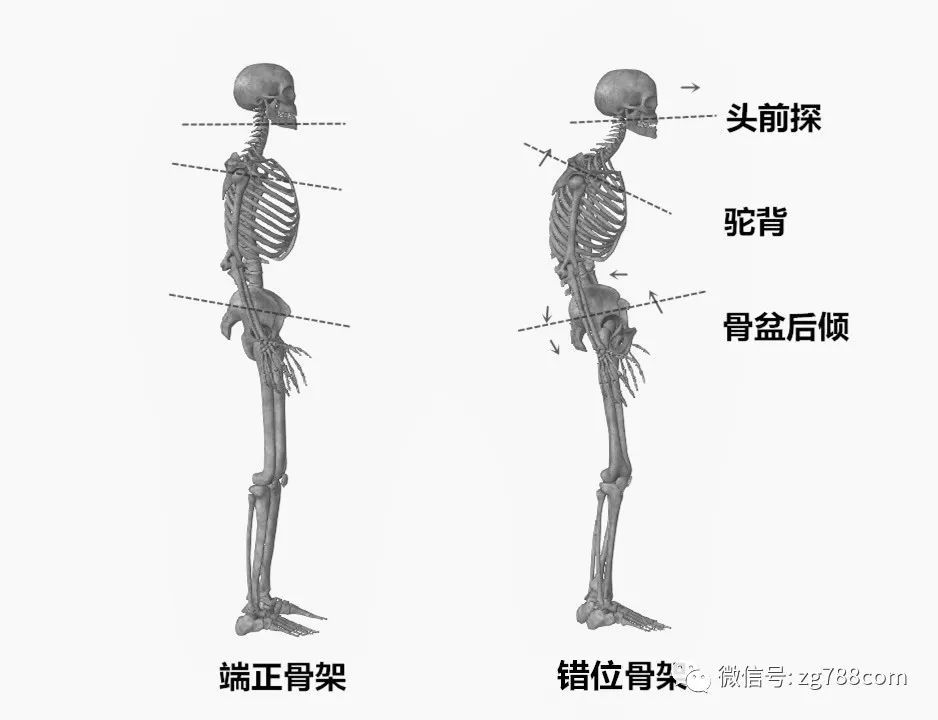 曲颈,驼背,塌腰会怎样?