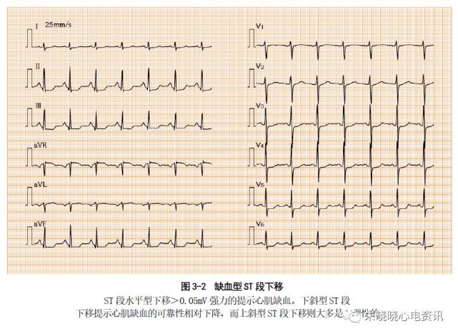 2,损伤型st段抬高指st段显著抬高(尤其呈弓背向上型.