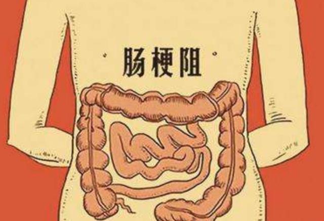 排便,排气成难题,肠道被肿瘤堵