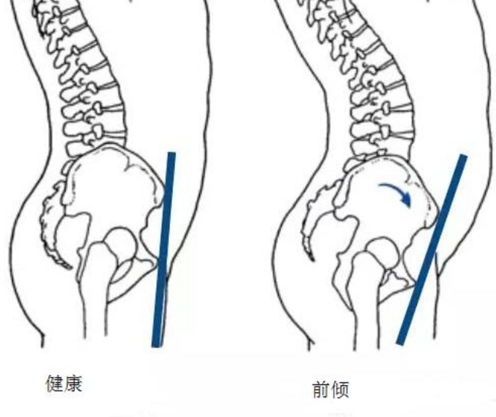 导致大肚腩,水桶腰的4个隐藏原因