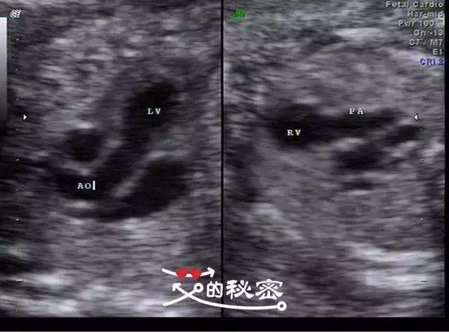 教你轻松看懂四维彩超报告,以及那些你不知道