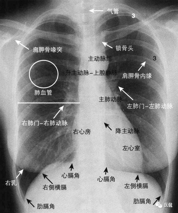 胸部正位片vs侧位片,都能得到什么有用信息?#医学影像