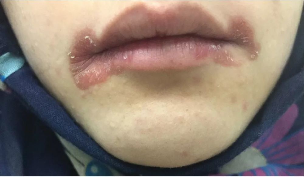 "烂嘴角"也是唇炎的一种,这是炎症蔓延到了口角区域引起了张嘴疼痛.