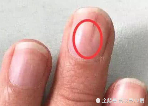指甲长出"竖纹",预示这3种疾病正向你靠近,别忽视这些
