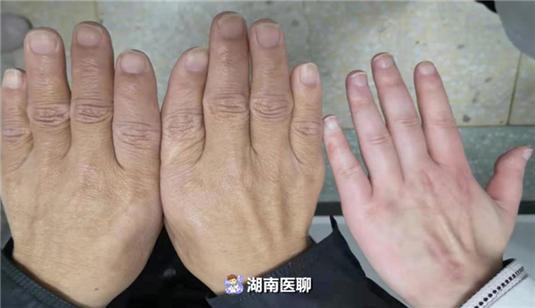 满月脸,水牛背?异常"高大威猛"莫忽视!有这些症状警惕罕见病