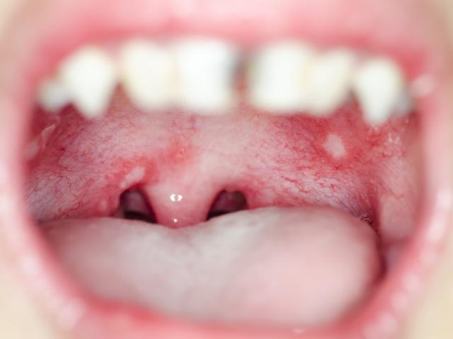 舌癌与口腔溃疡"长得像",通过这些方法区别,别耽误治疗