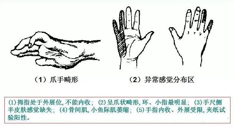 10.尺神经损伤