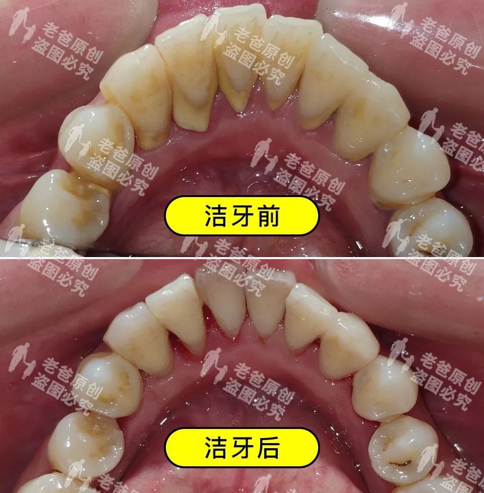 纠结要不要洗牙的,请认真看这篇文章
