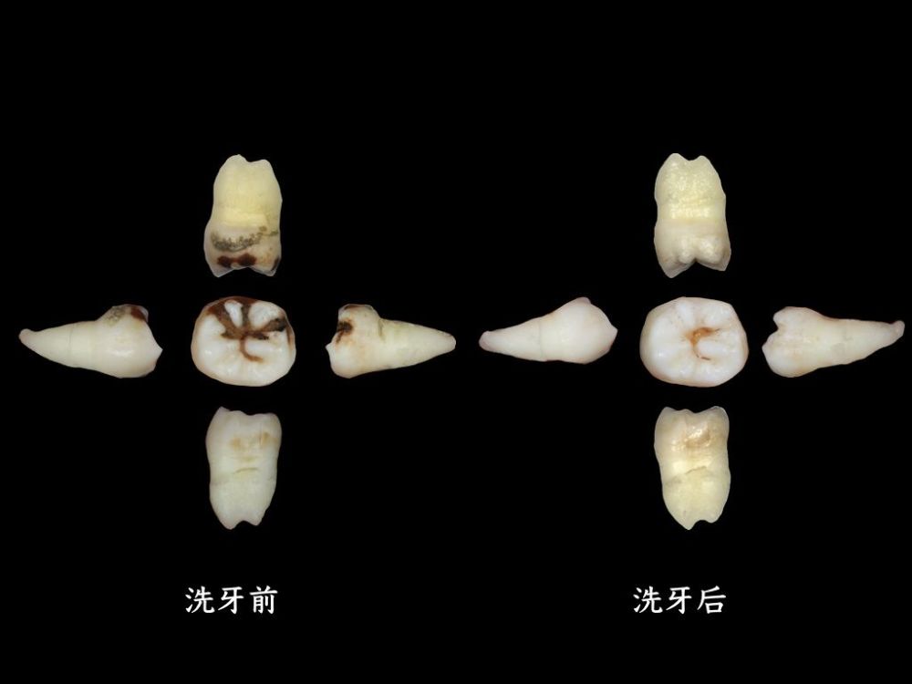 然后就是对牙齿进行牙面光洁.