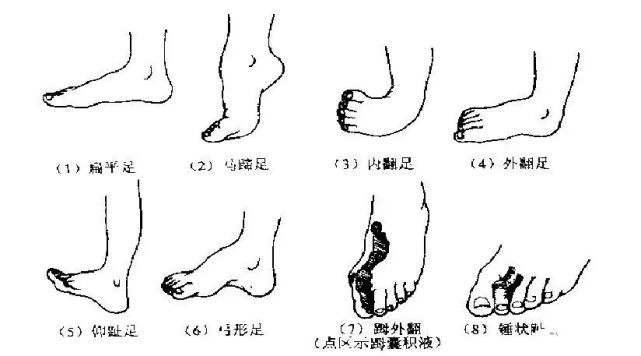 1.常见的足部畸形(六)足踝部损伤检查法7.交叉韧带损伤检查6.