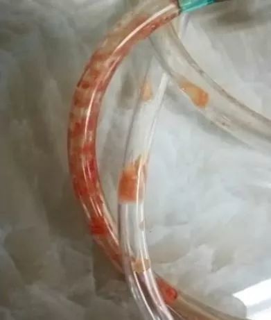 因为吃这个水果,1岁男孩心脏停跳40多分钟,家