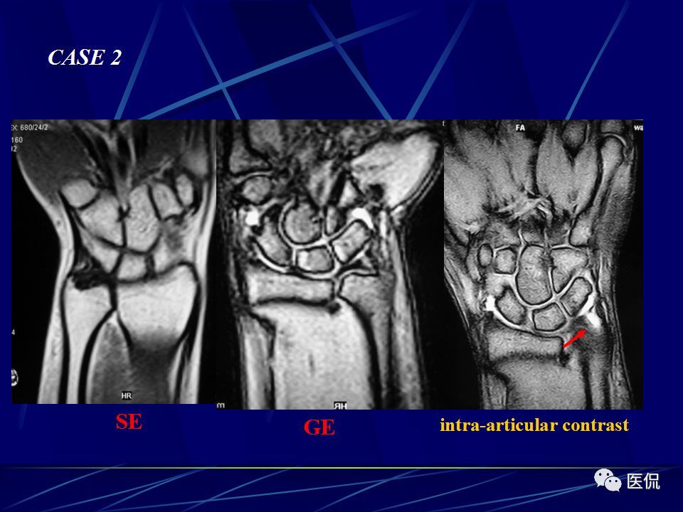 腕关节的mri解剖影像及诊断#医学影像经典ppt