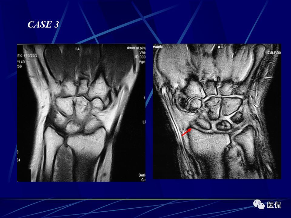 腕关节的mri解剖影像及诊断#医学影像经典ppt