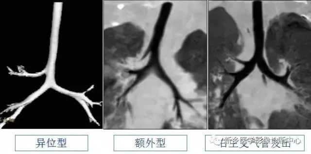 气管性支气管