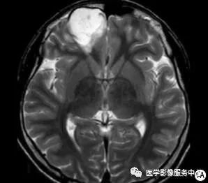 这例头颅ct片中,你能找到病变吗?#医学影像病例