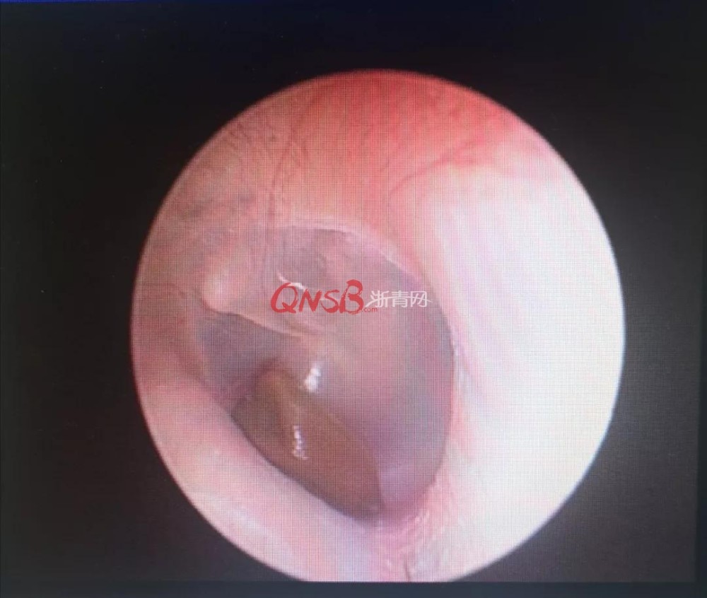杭州一外教总觉得耳朵里咕噜响,里面竟然长