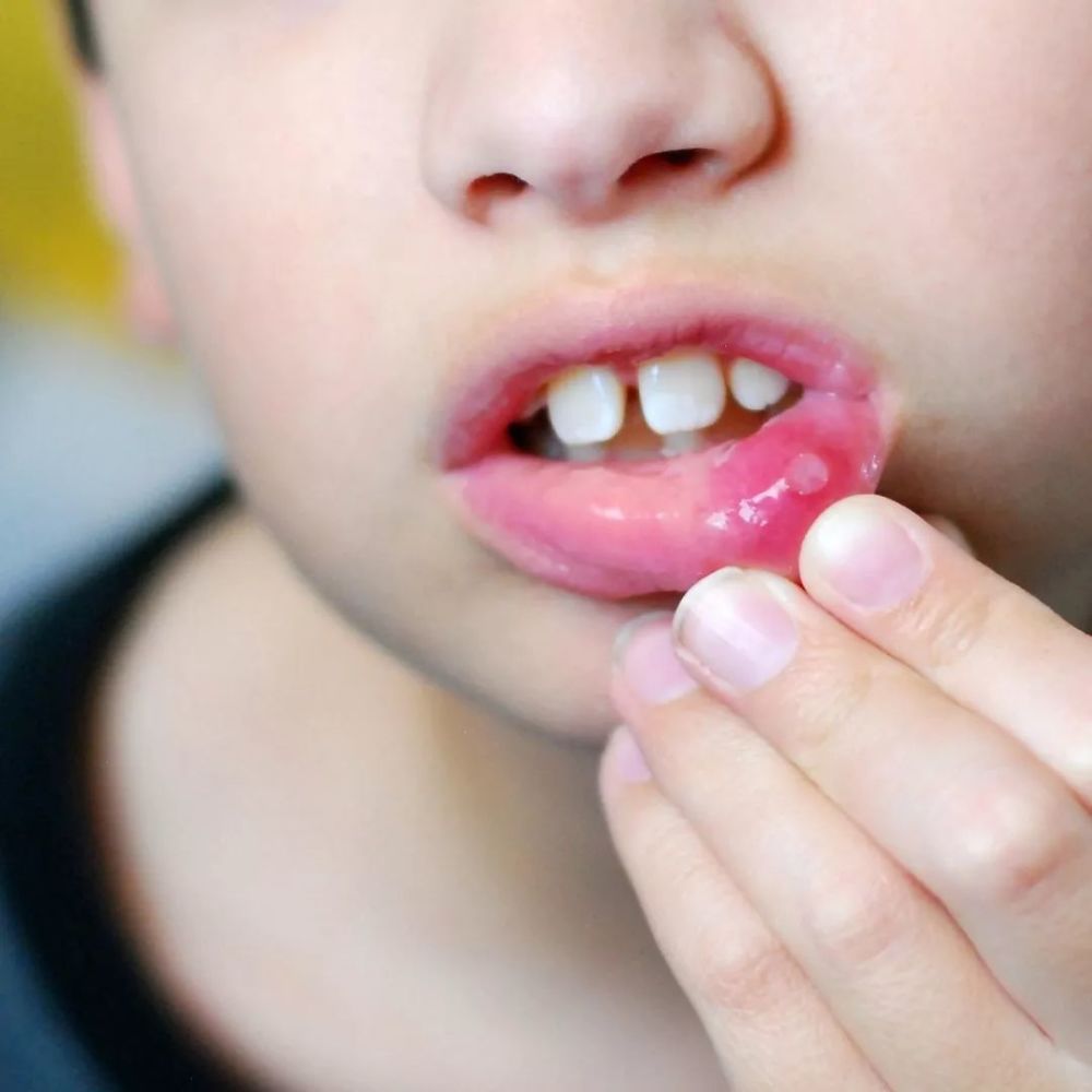 有发热和颈部淋巴结肿大,疱疹可发生于口腔里面任何部位,常见于齿龈