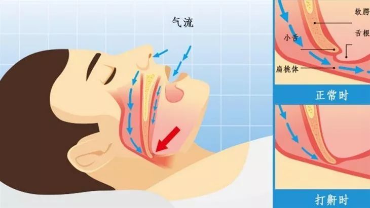 世界睡眠日 | 打呼噜是病,重了,要命!