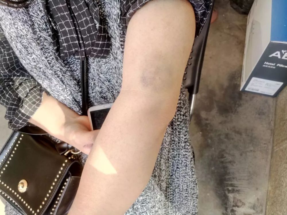 小吴手臂上有淤青
