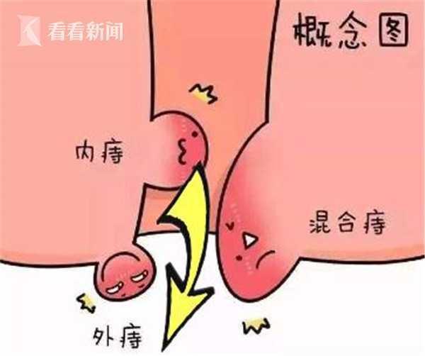 "十人九痔"不是玩笑!把辣条当饭吃,32岁小伙内痔掉出肛门外