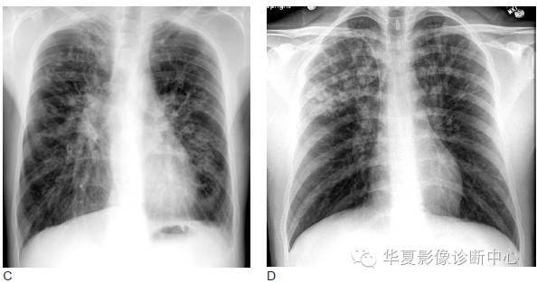 肺囊性纤维化