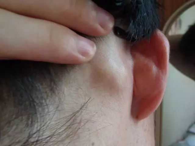 容易堆积在耳朵后面,时间长了就会形成皮脂腺囊肿