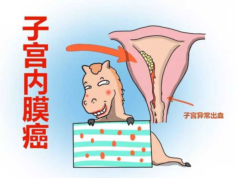 子宫内膜癌or子宫内膜异位症,你能区分吗?