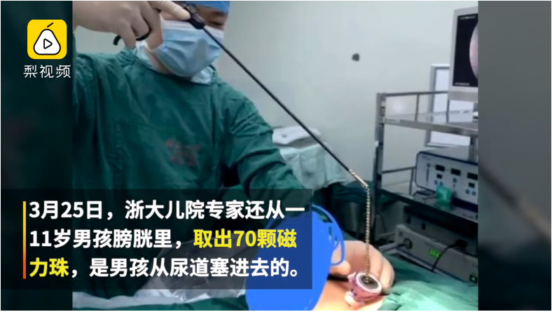 11岁男孩将磁力珠塞进尿道,医生从膀胱取出70颗