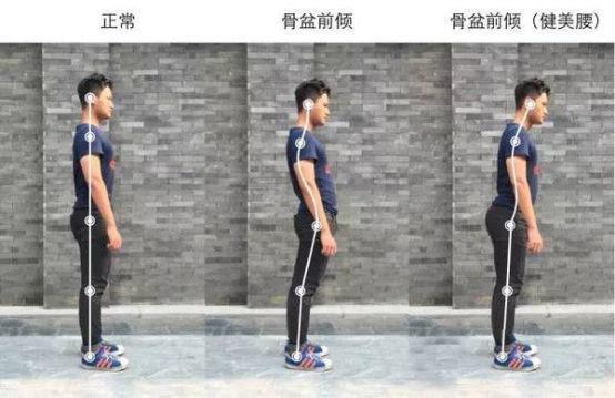 什么是骨盆前倾,又该怎么改善?一起来看看吧