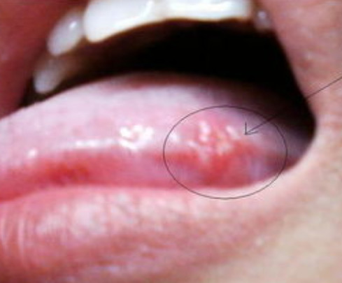 在感染上艾滋病病毒以后,口腔中会出现很多的白色念珠菌,这种白色