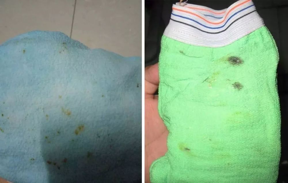 导致长时间滋生a细菌细菌,感染状态和真菌处于,搓背容易引起感冒加上吃冬季交叉病毒性什么药图片