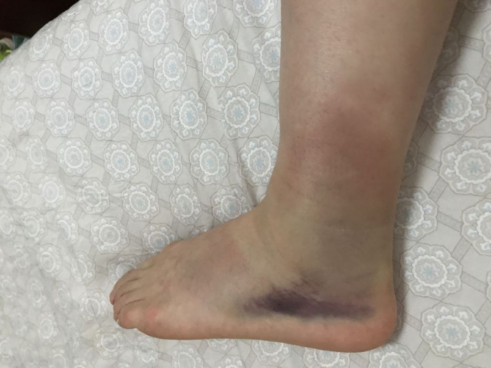 脚踝肿成馒头赛前3天才能训练 辣妈吴静钰复出两个月