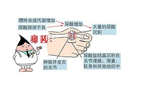 痛风占总人口比例_痛风的症状图片