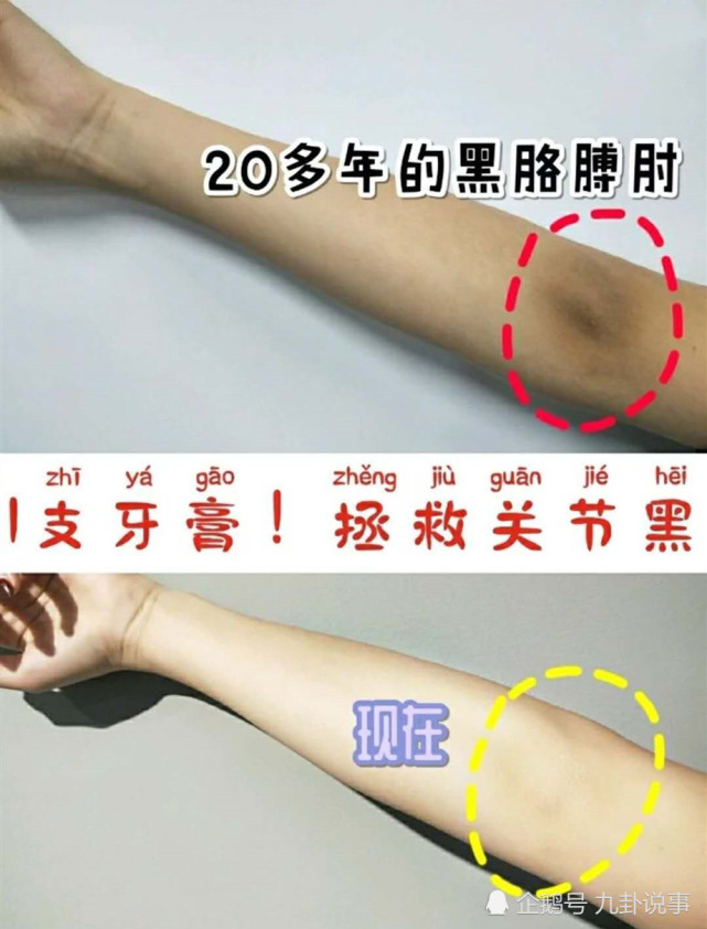 首先我们要知道为什么膝关节和肘关节会发黑,一个原因是先天性因素